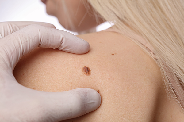 Removal of skin lesions