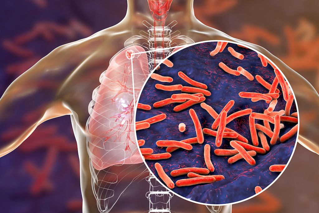 tuberculosis.
